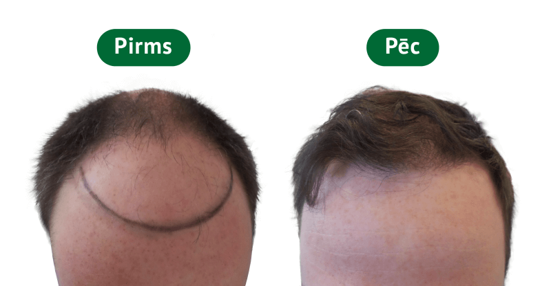 Пересадка волос - результат до и после