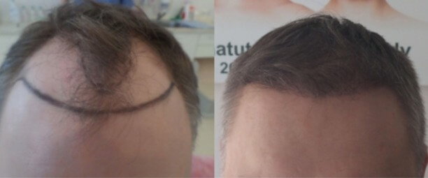 Трансплантацию волос проводят в клинике Rubenhair.